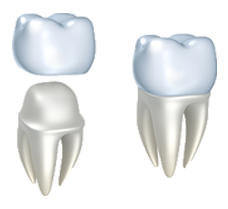 Porcelain Crowns and Bridges