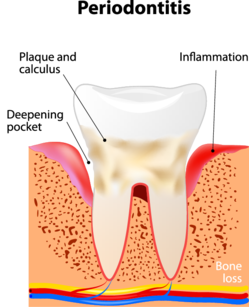 Periodontal Surgery